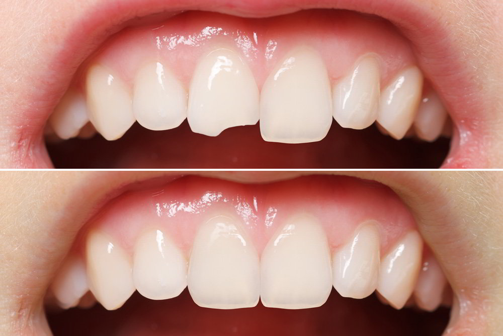 Каким образом в современной стоматологии выполняется восстановление зубов.